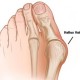 Hallux Valgus - OA Dr. Wilfried Materna