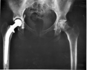 Hüftgelenksabnützung (Coxarthrose)